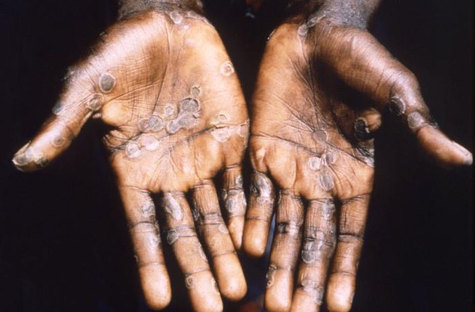 Britain report cases of monkey pox