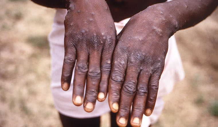 first patient of monkey pox died in China